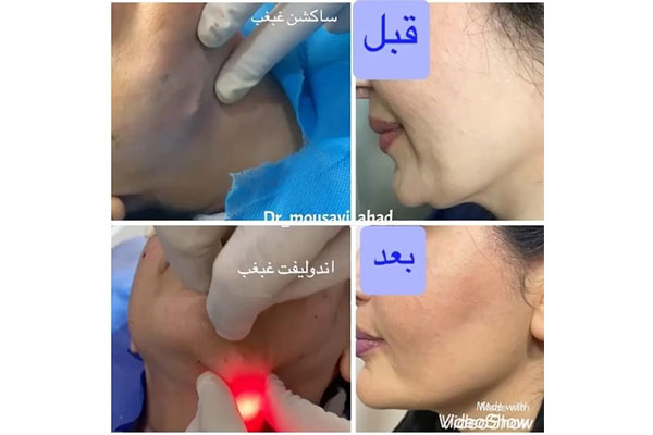 بهترین روش رفع غبغب | بررسی روش‌های بدون جراحی و با جراحی